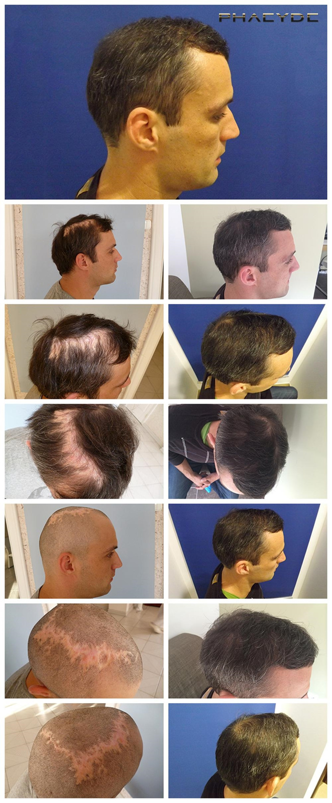 Hair transplant&nbsp;before&nbsp;after&nbsp;photos&nbsp;and&nbsp