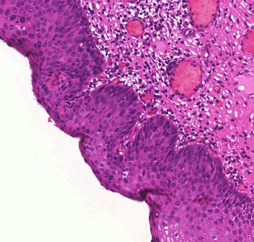 cervix in situ carcinoma dyasplasia