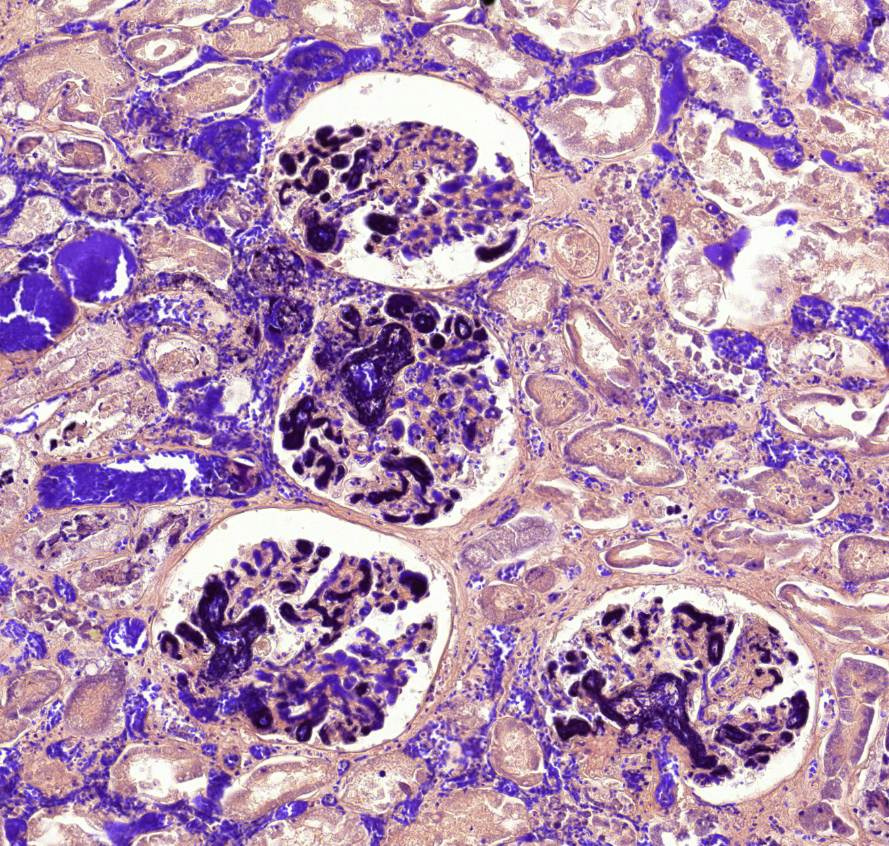 DIC (fibrin festes) 3