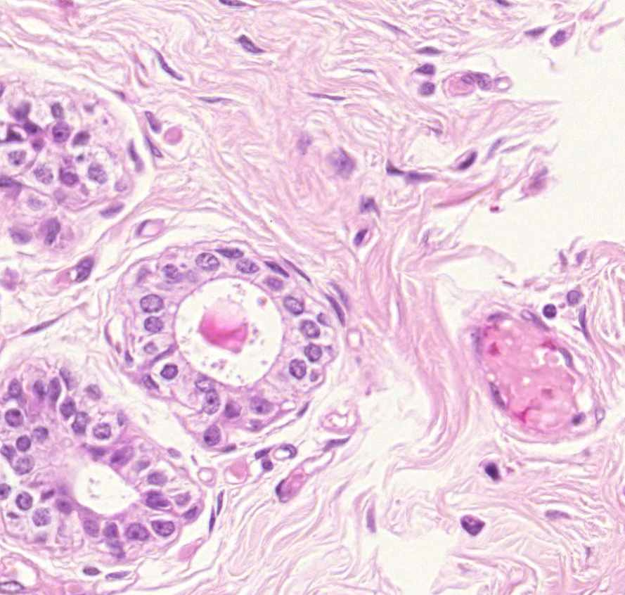 carcinoma ductale invasivum mammae myoepithel