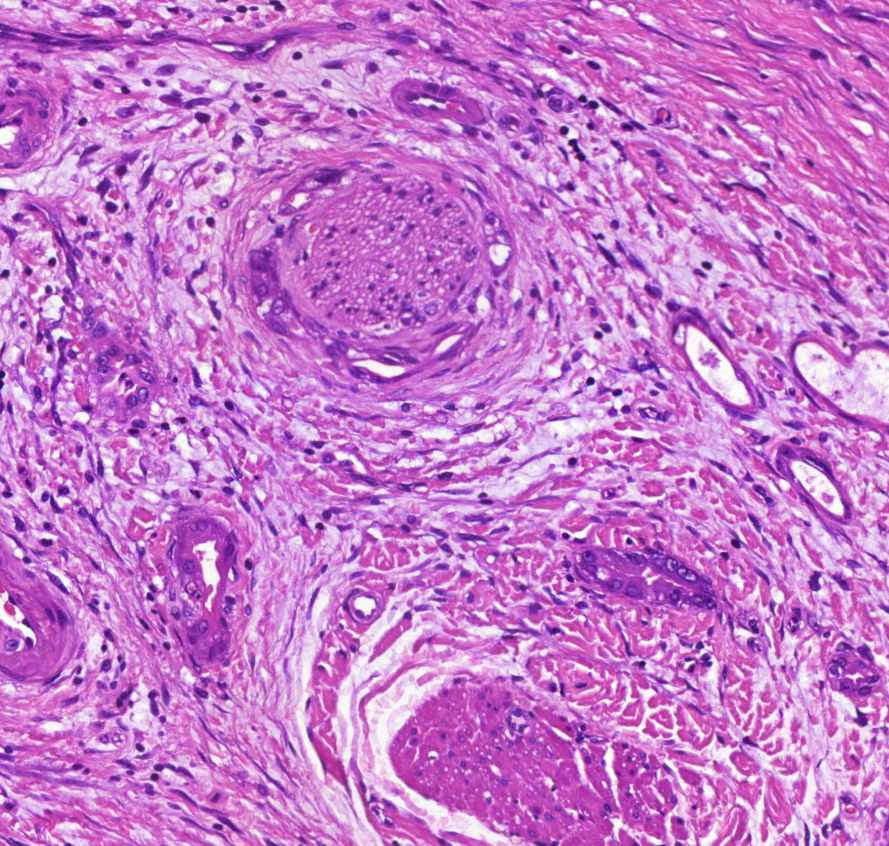 carcinoma pancreatis perineurális terjedés