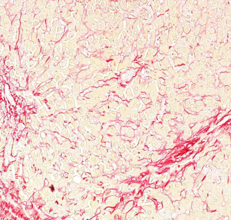 cirrhosis hepatis (picro)1