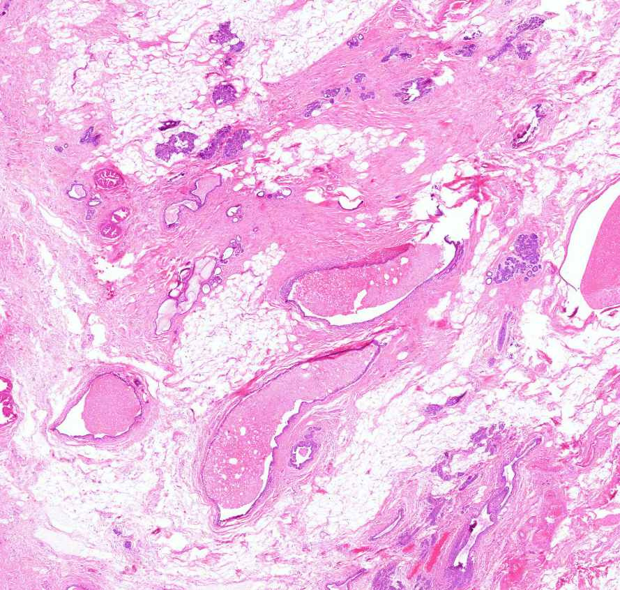 mastopathia fibrocystica fibrosis