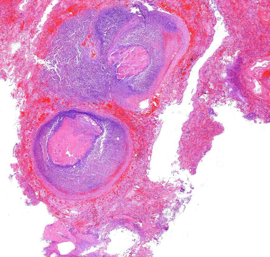 abscessus pulmonis