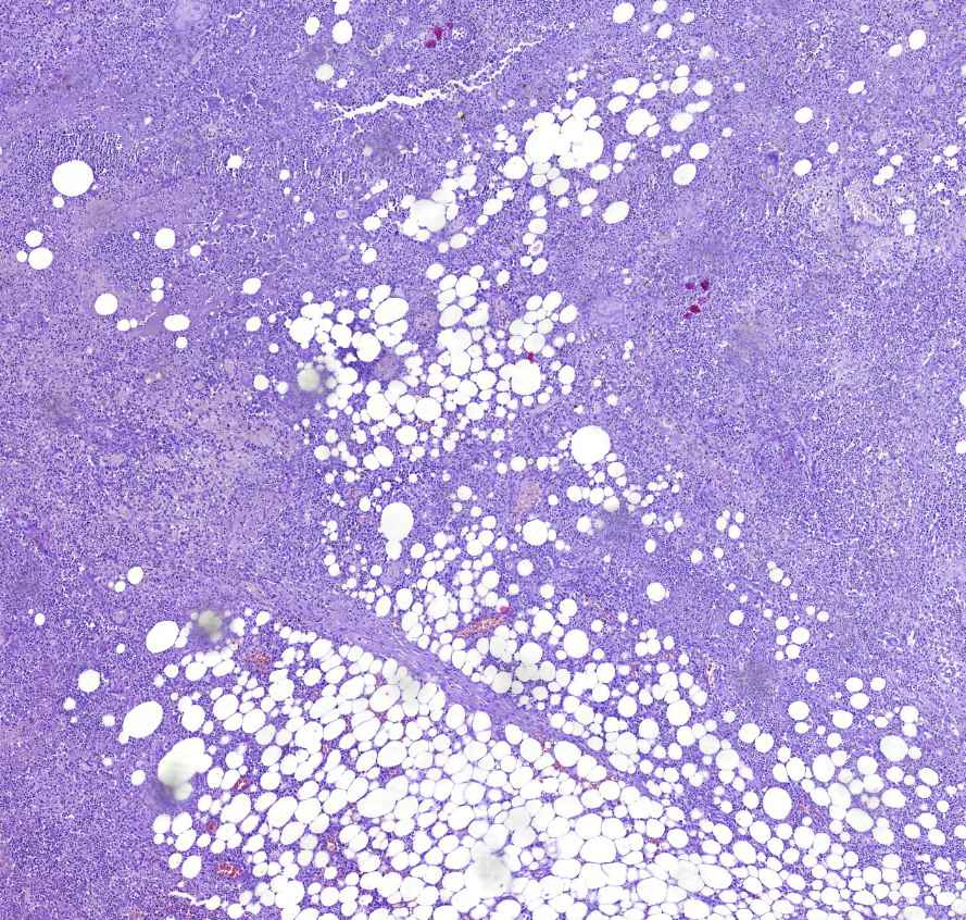 actinomycosis zsír