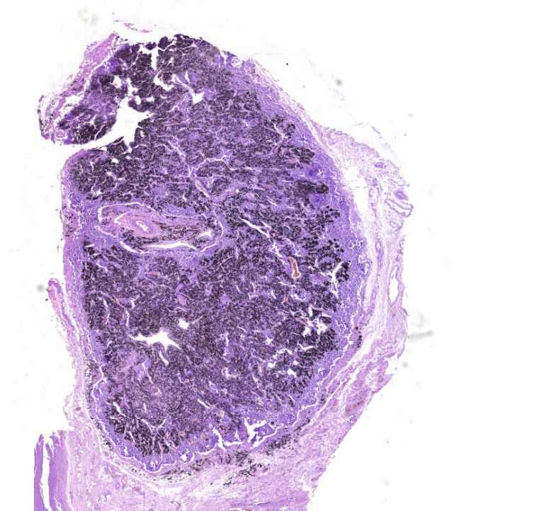 Anthracosis lymphnodi0