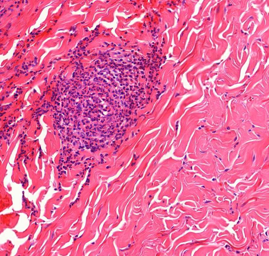 autoimmun vasculitis elpusztult benne az ér