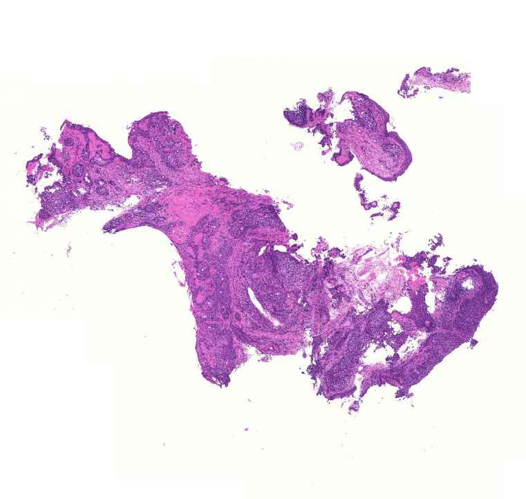 bronchus-metaplasia-dysplasia-carcinoma0