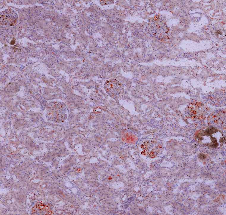 Fat embolisation in kidney1