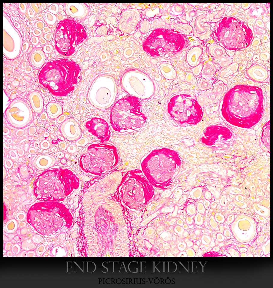 end-stage kidney