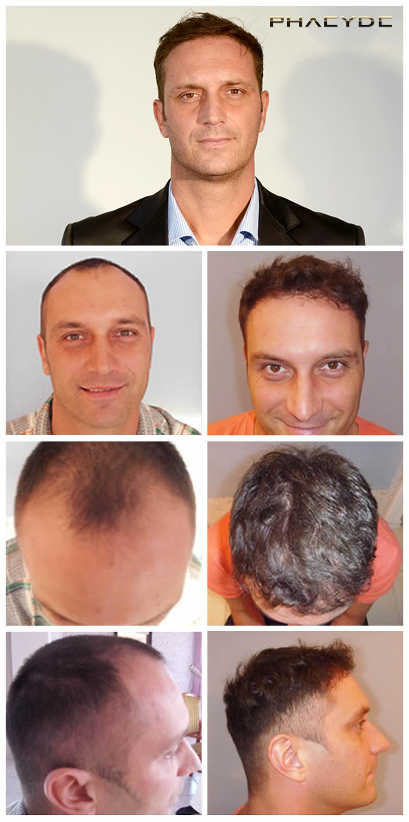 Hair Transplant van 4000+ Haren- PHAEYDE Clinic