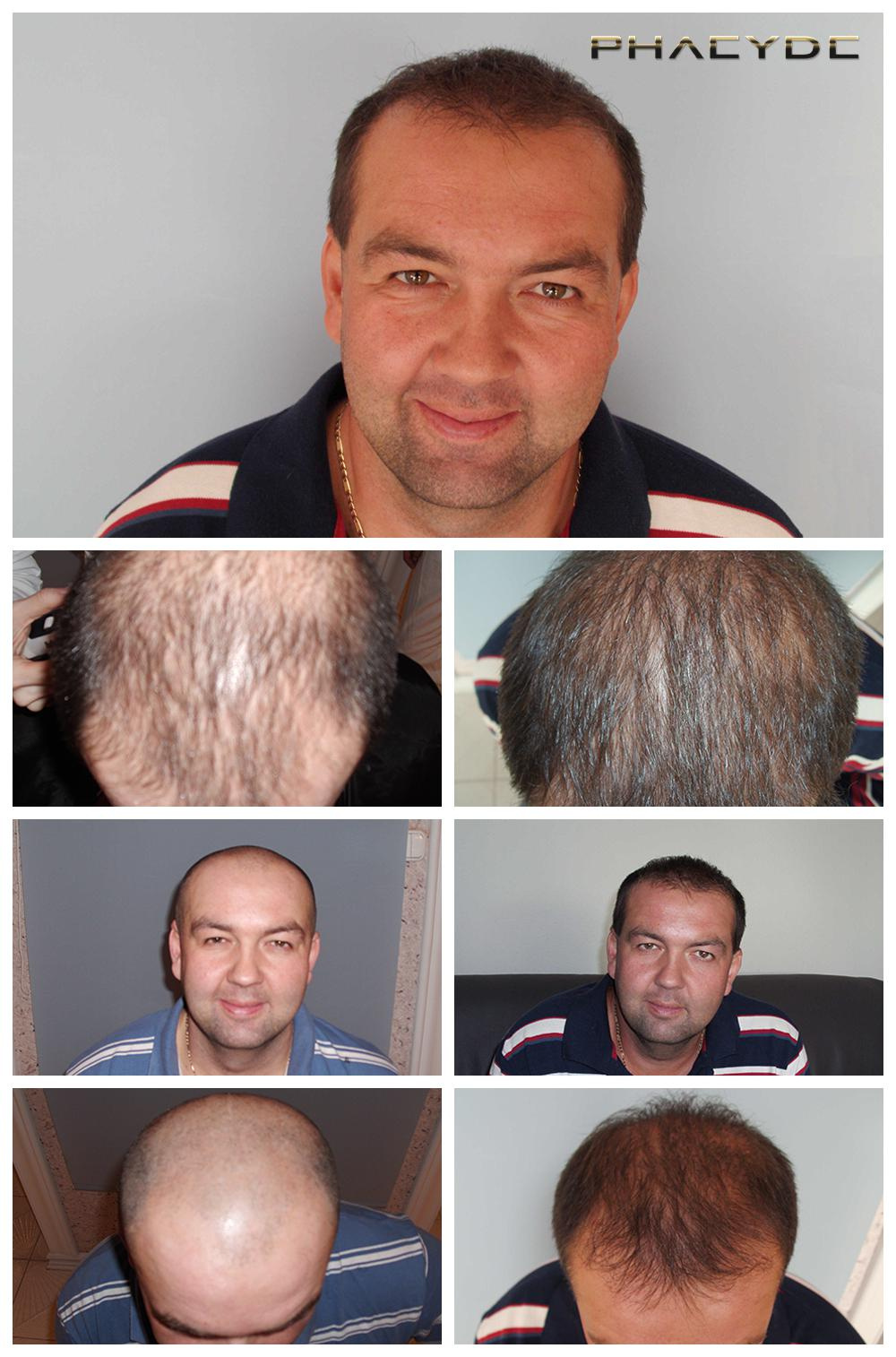 FUE haartransplantatie 8000+- PHAEYDE Clinic