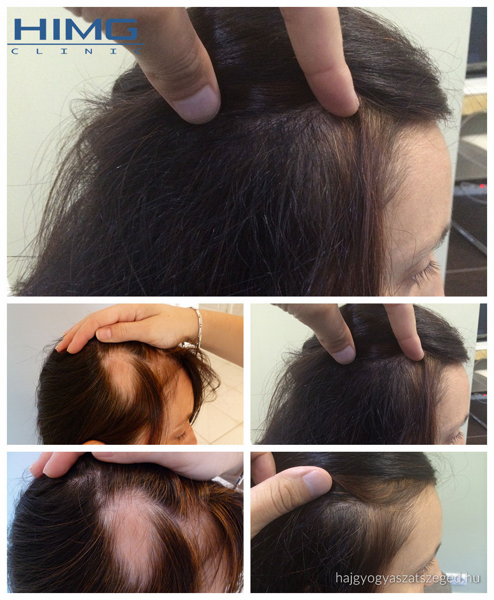 D. Réka - női foltos hajhullás, 1500 hajszál beültetése - HIMG K