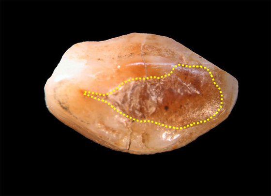 ancient-tooth-filling méhviasszal töltött fog 6500 éves